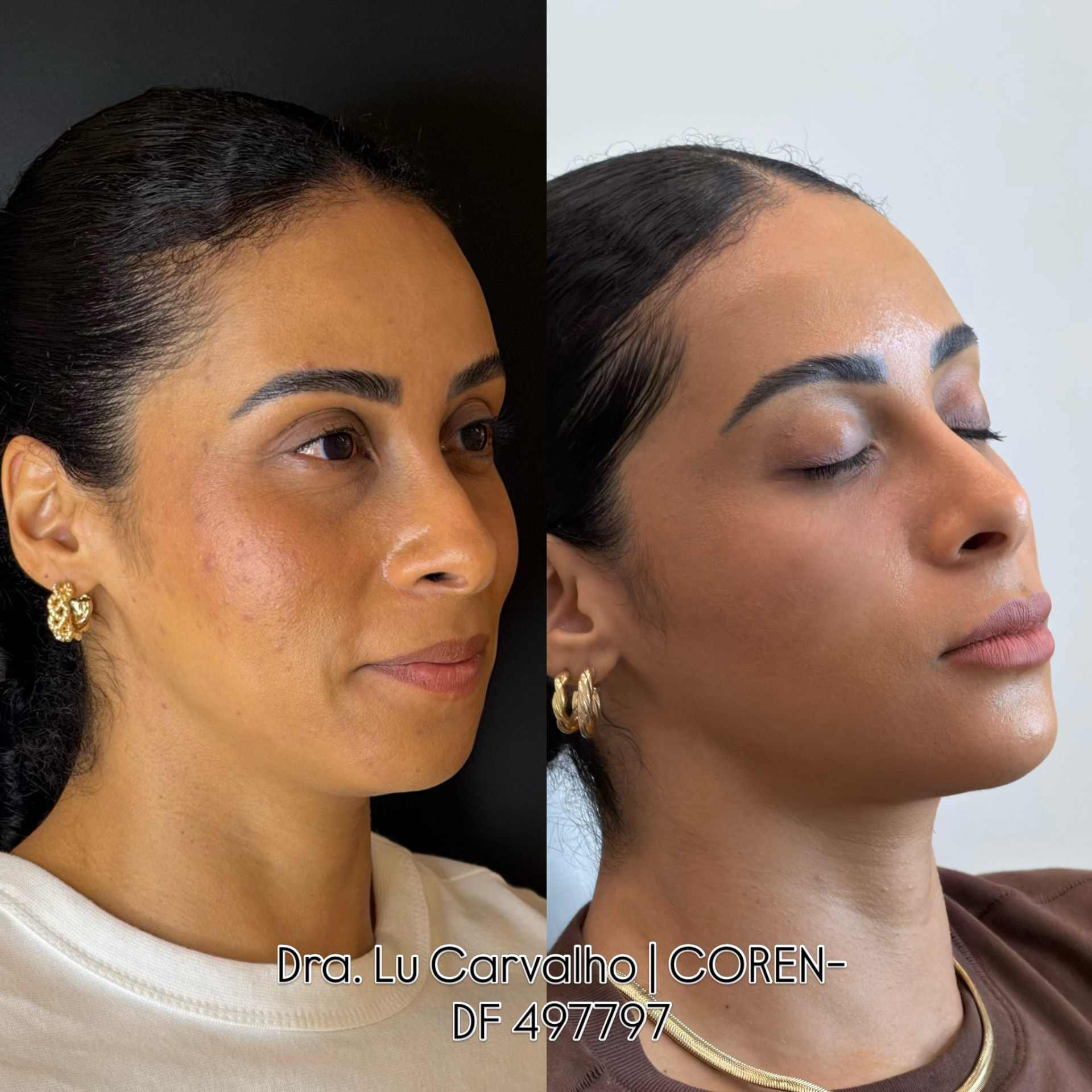 Resultado de perfilometria e contorno facial